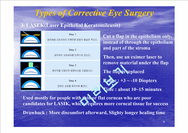 Refrative Laser Eye Surgery   (8 )